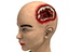 Girl with severe Head Injury